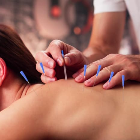 Acupuncture needles placed along a patient's back at Bhargavi Health World