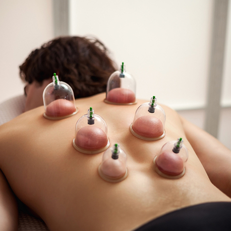 Cupping therapy